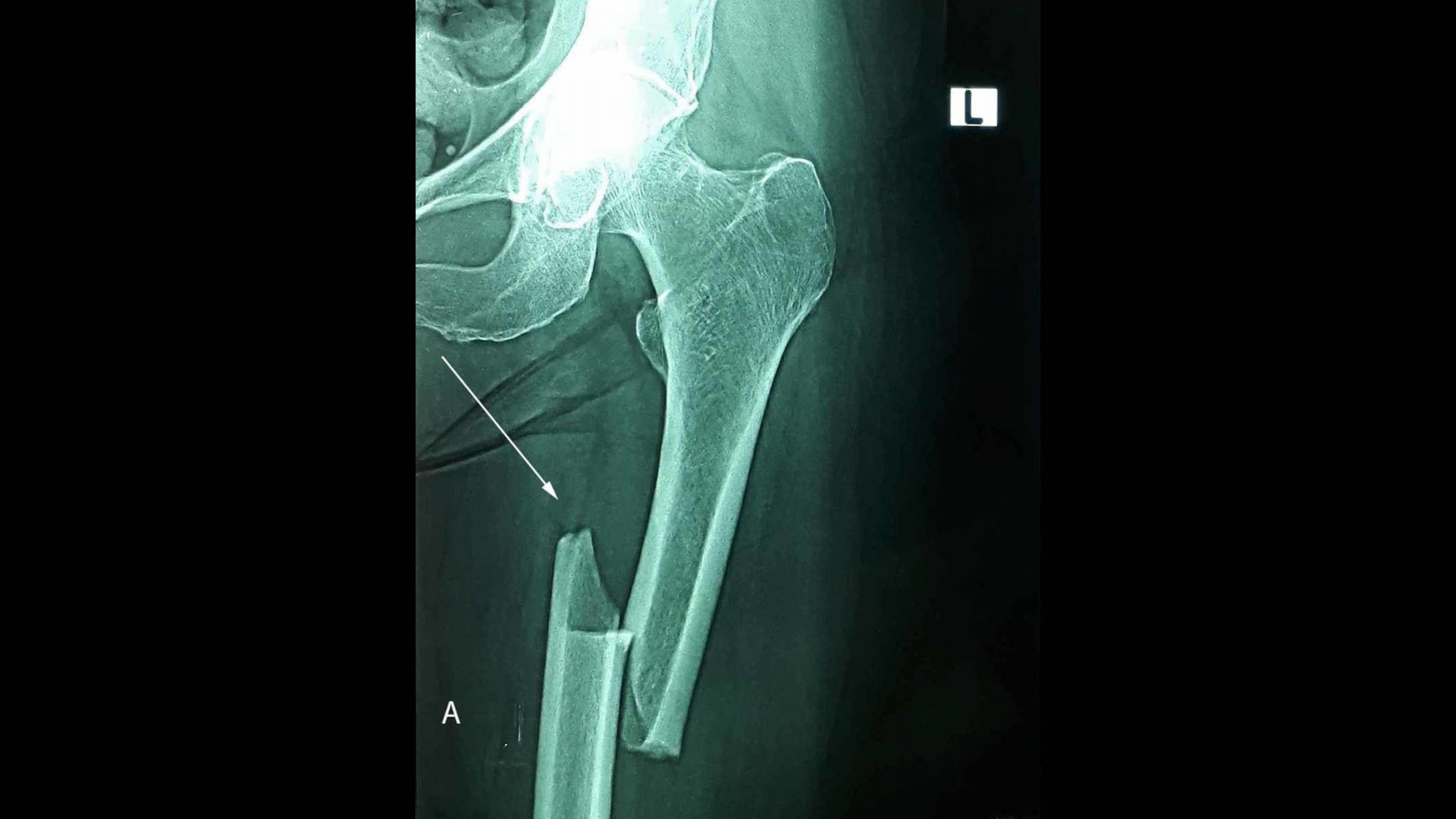 Radiology Image Of Atypical Femoral Fracture