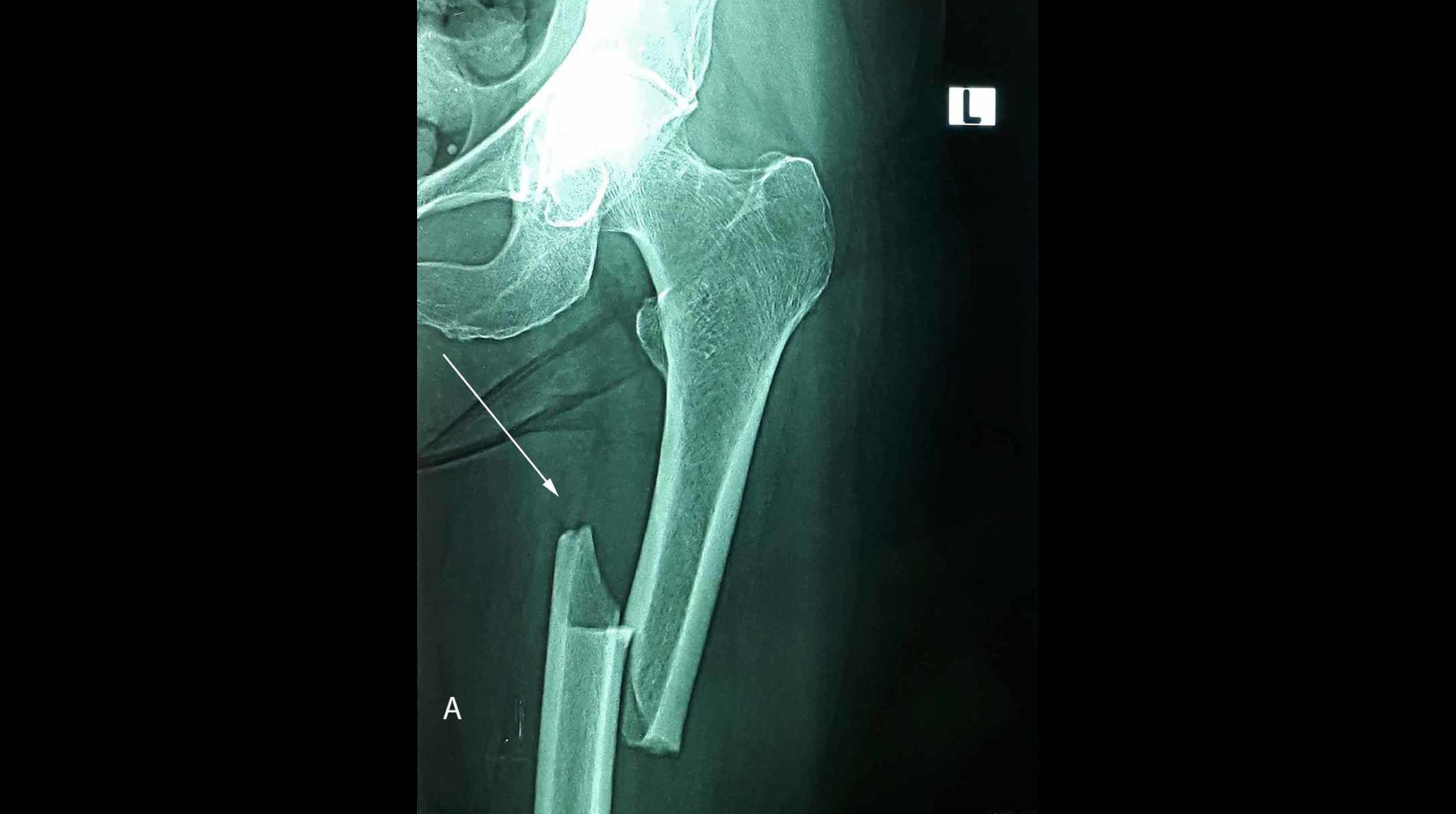 Bisphosphonates and Atypical Femoral Fractures: An Update | NYU Langone ...