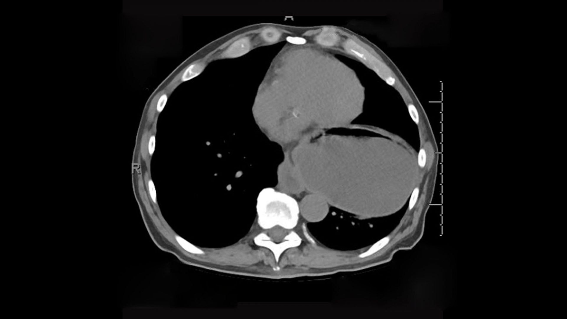 Axial View of CT Scan Showing Large Intrathoracic Stomach