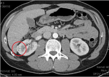 CT Scan with Mass