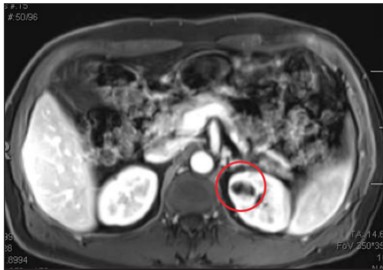 CT Scan with Cyst