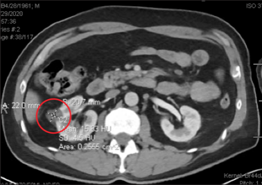 CT Scan Showing Carcinoma
