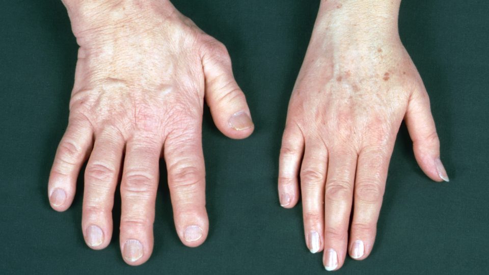 Image Of Patient's Hands With Acromegaly