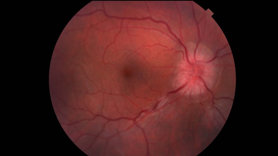 Image of Optic Neuritis