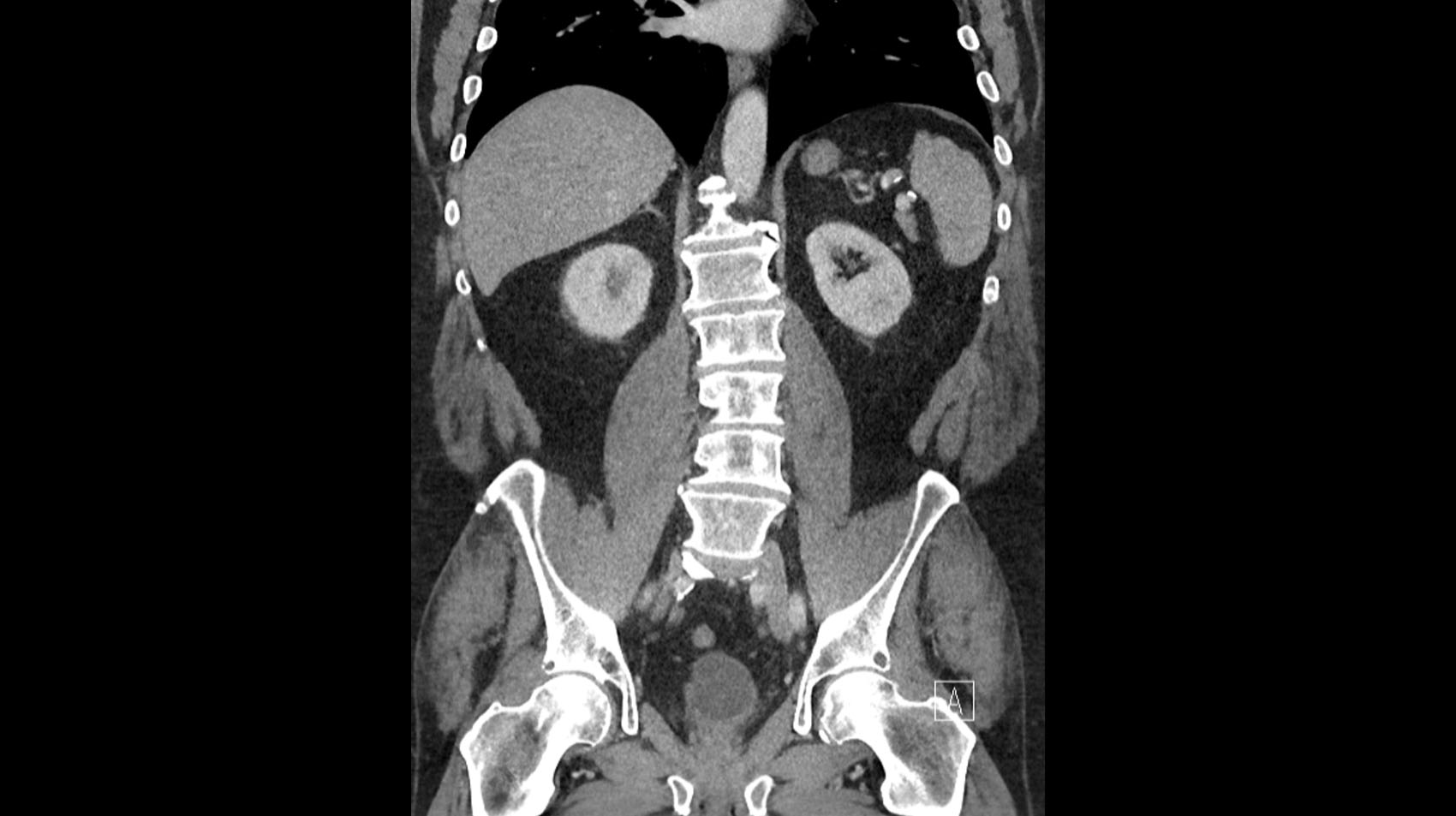 Patient’s CT Urogram Prior To Enrollment In CheckMate 9UT