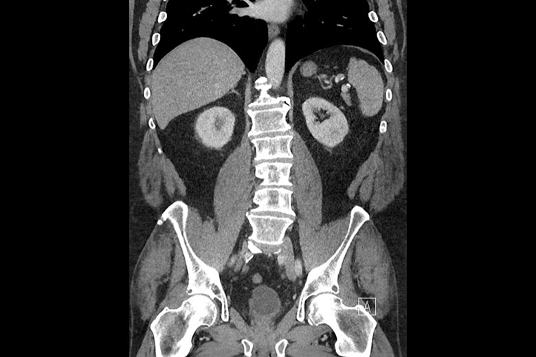 Patient’s CT Urogram Prior To Enrollment In CheckMate 9UT