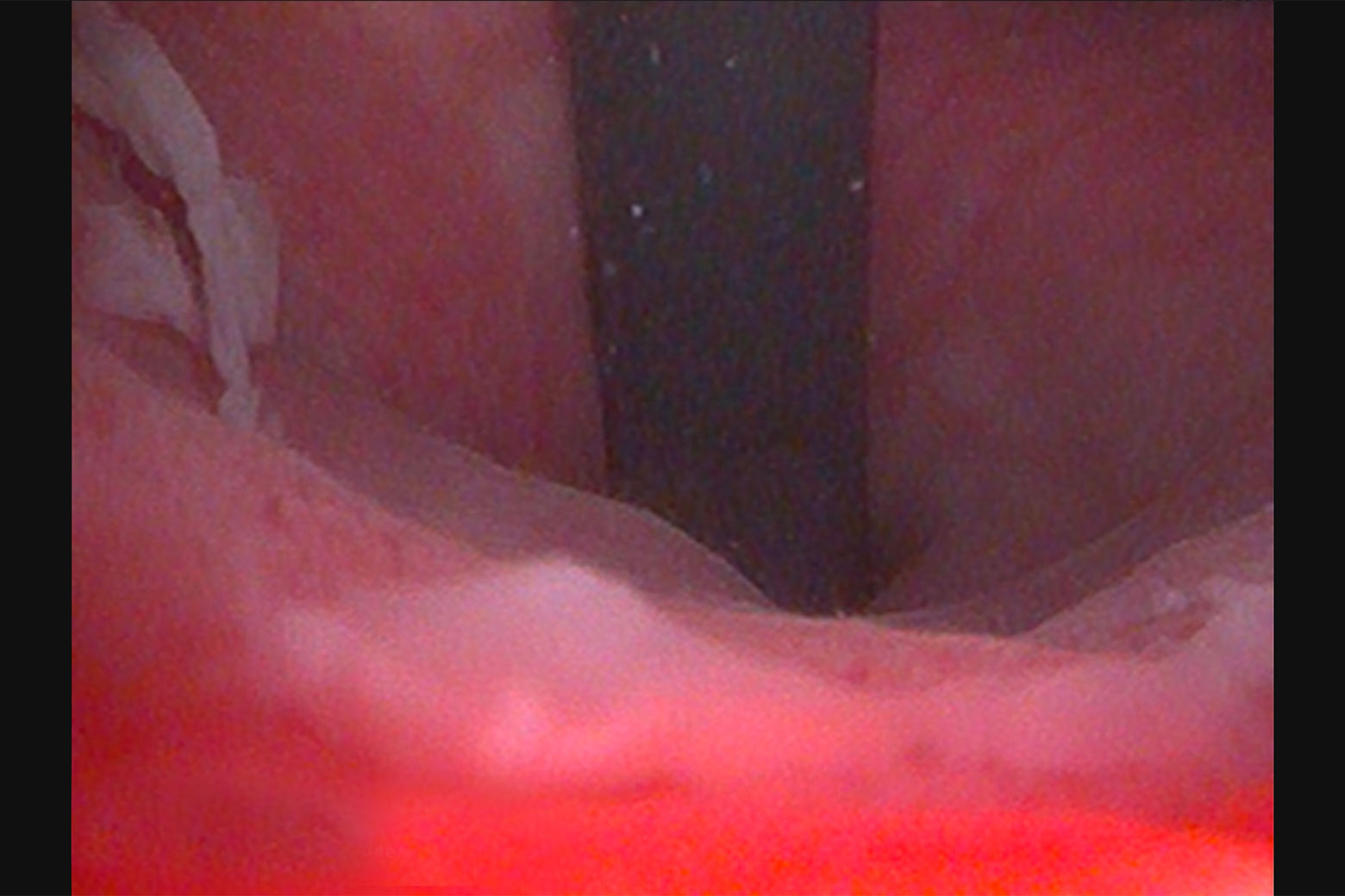 Image From Cystoscopy Revealing Diffuse Erythema, Inflammation And Carcinoma In Situ
