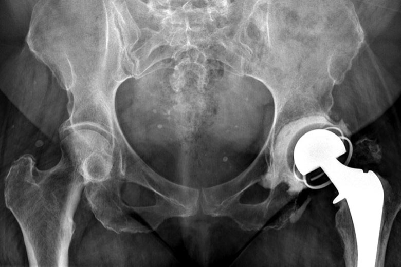 Pelvic X-Ray Showing Loss of Left Trochanter