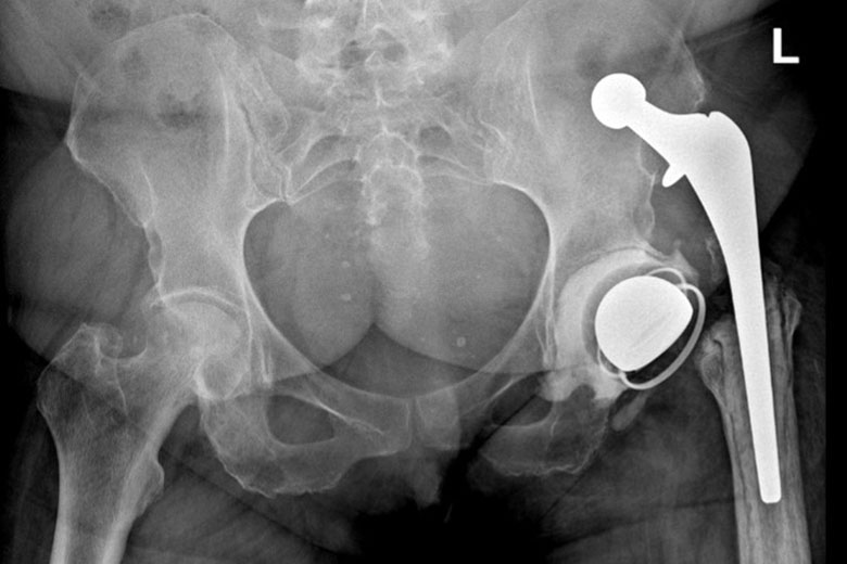Pelvic X-Ray Showing Dislocation of the Implant from the Left Femur