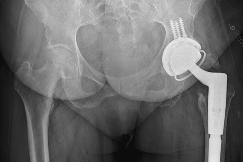 Pelvic X-Ray Showing Final Implant