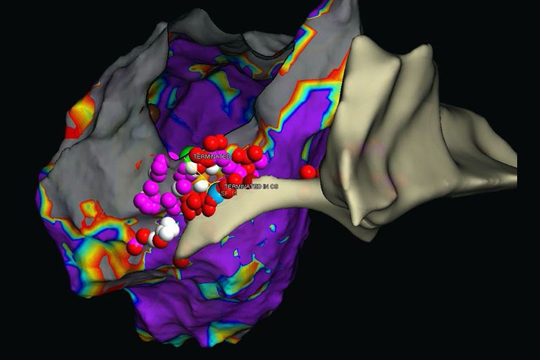 3D Map Of A Patient's Heart