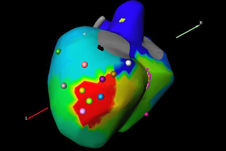 Non-Invasive Program Stimulation (NIPS)