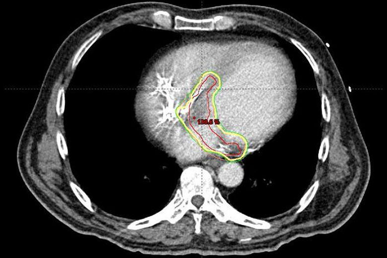 Cardiac CT Scan