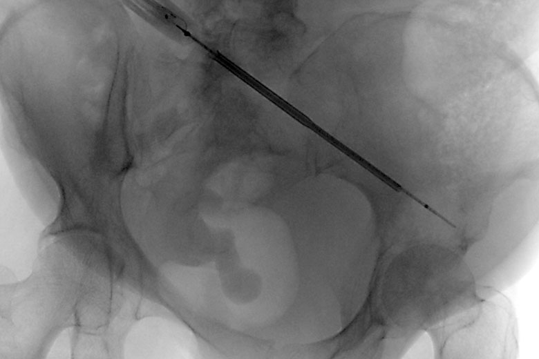 ablation placement x-ray