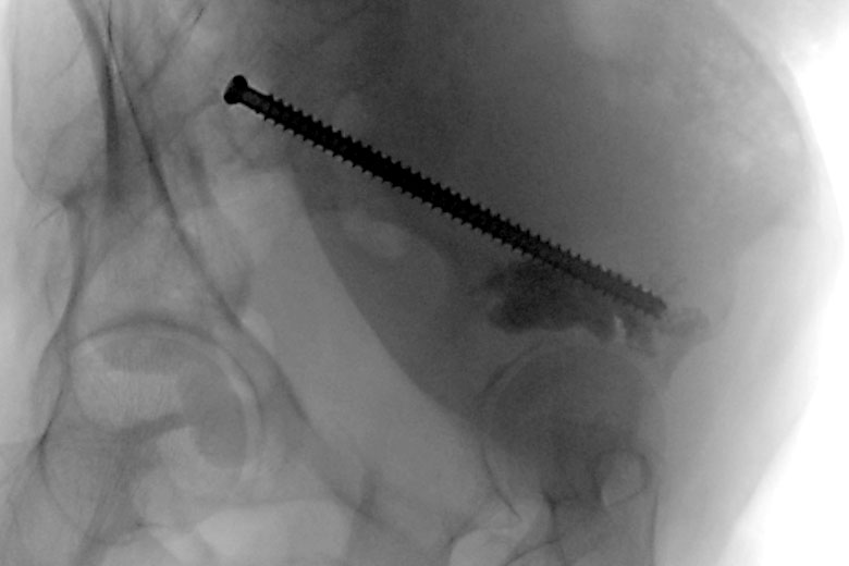 screw placement x-ray