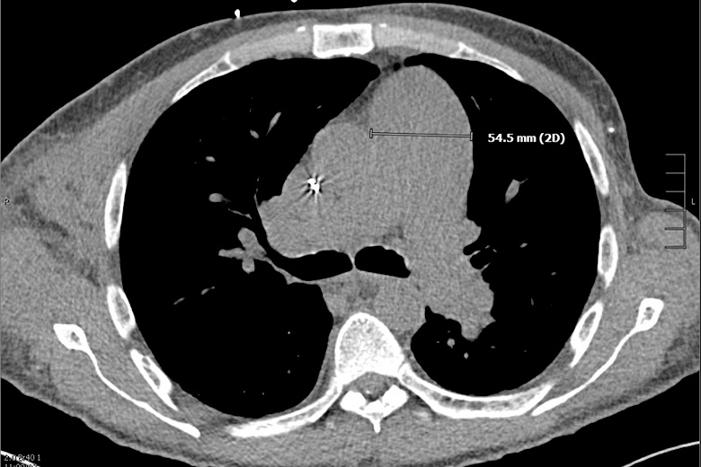 Initial CT scan