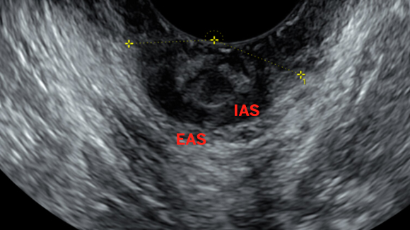 Endoanal ultrasound indicates the degree of separation of the external (EAS) and internal anal sphincters (IAS). Yellow dash marks indicate dehiscence of the sphincter complex 150 degrees.