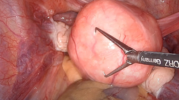 The patient’s uterine remnant, vulnerable to aggressive fibroid growth.