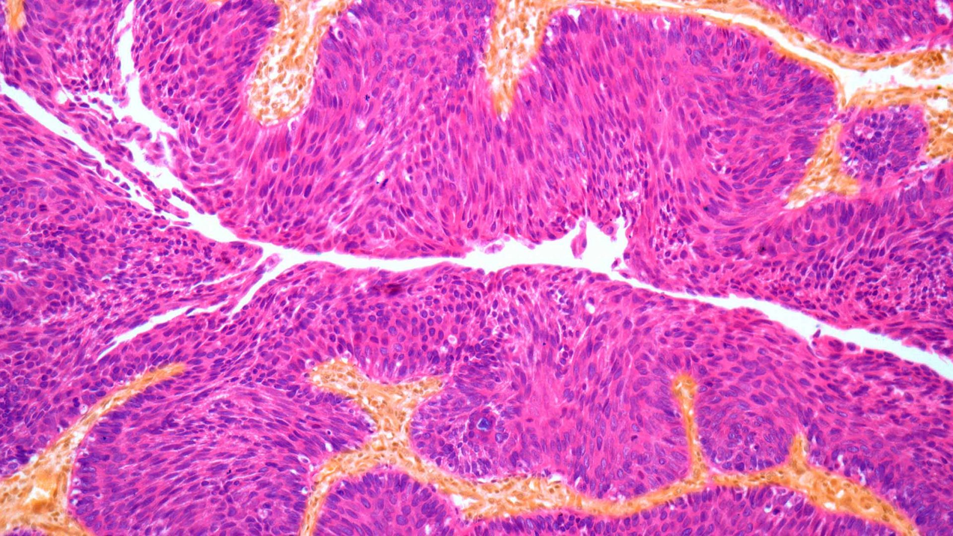 Light Micrograph of Section Through a Transitional Cell Carcinoma of the Bladder Wall