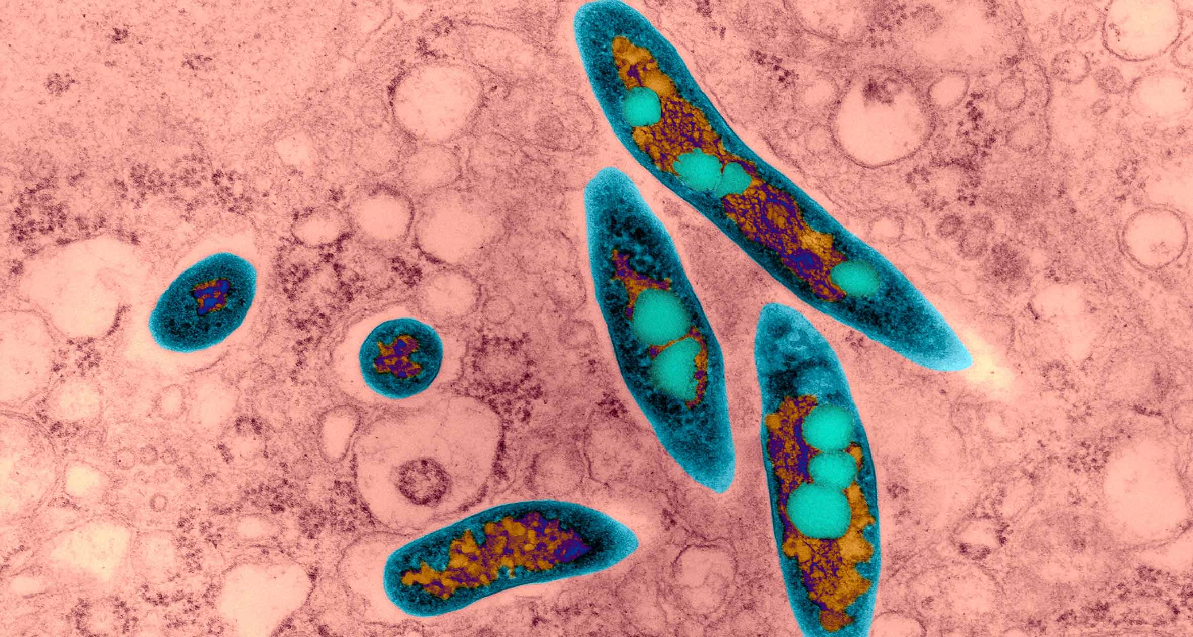 advancing-treatment-of-bronchiectasis-nontuberculous-mycobacteria