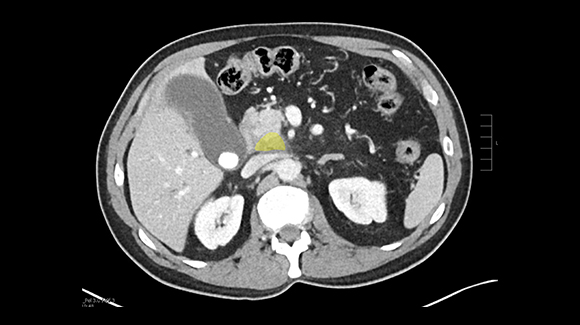 Imaging reveals a pancreatic tumor (yellow) located near the inferior vena cava (IVC).