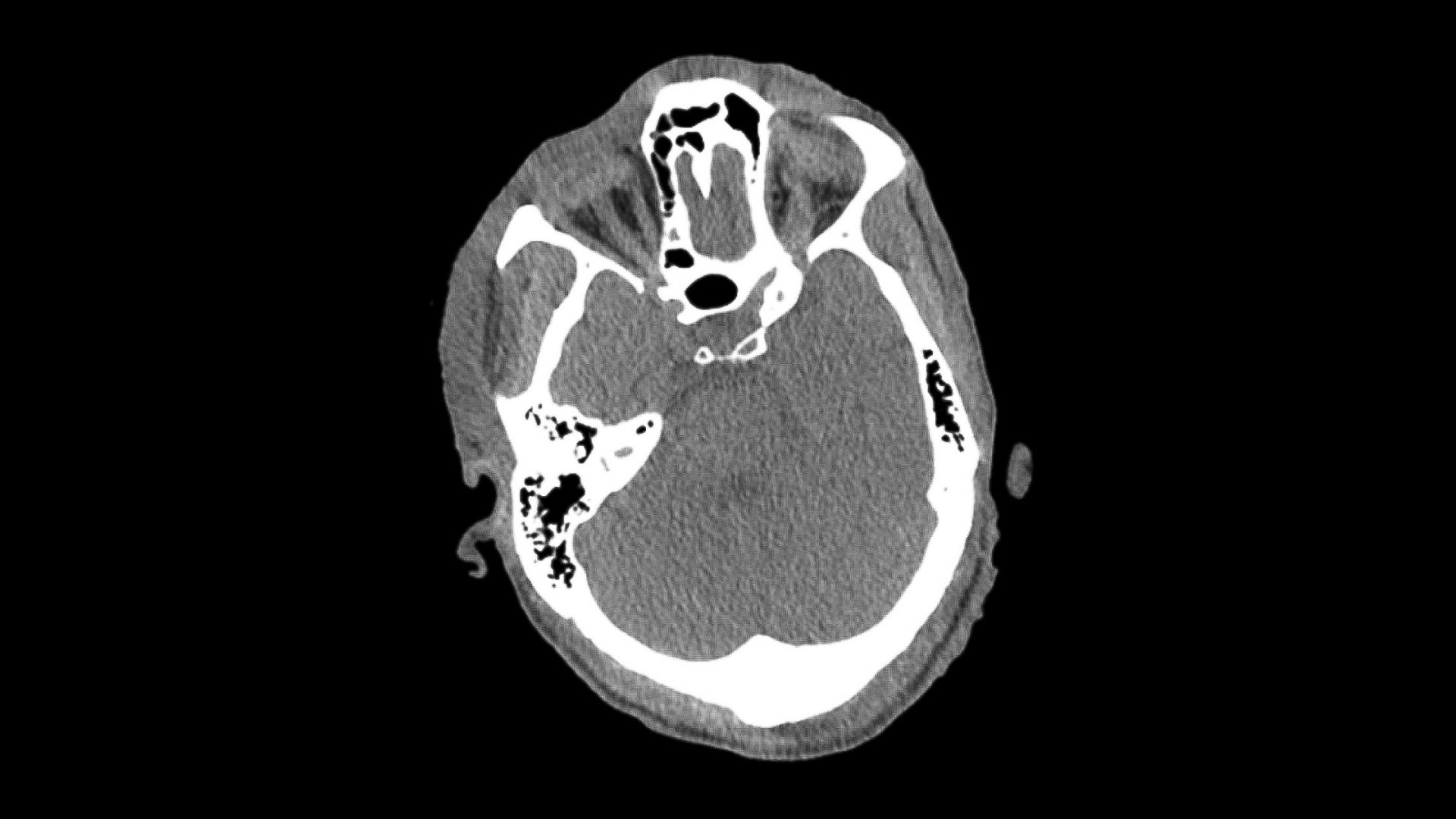 CT Scan of Bilateral Globe Compromise in Patient with Mpox