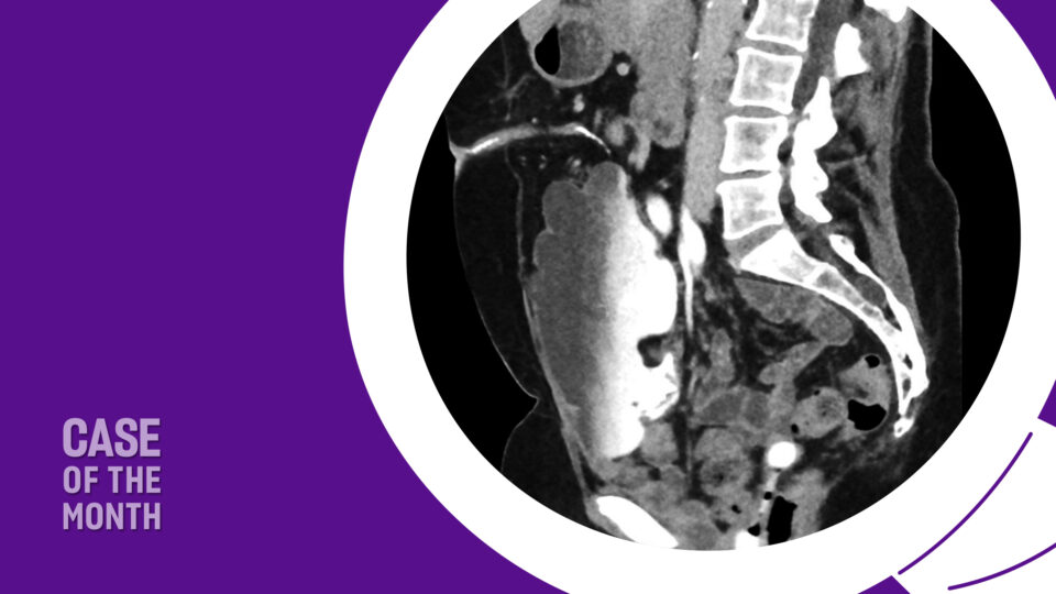 When Sacrocolpopexy Is the Best Choice for Post-Cystectomy Prolapse ...