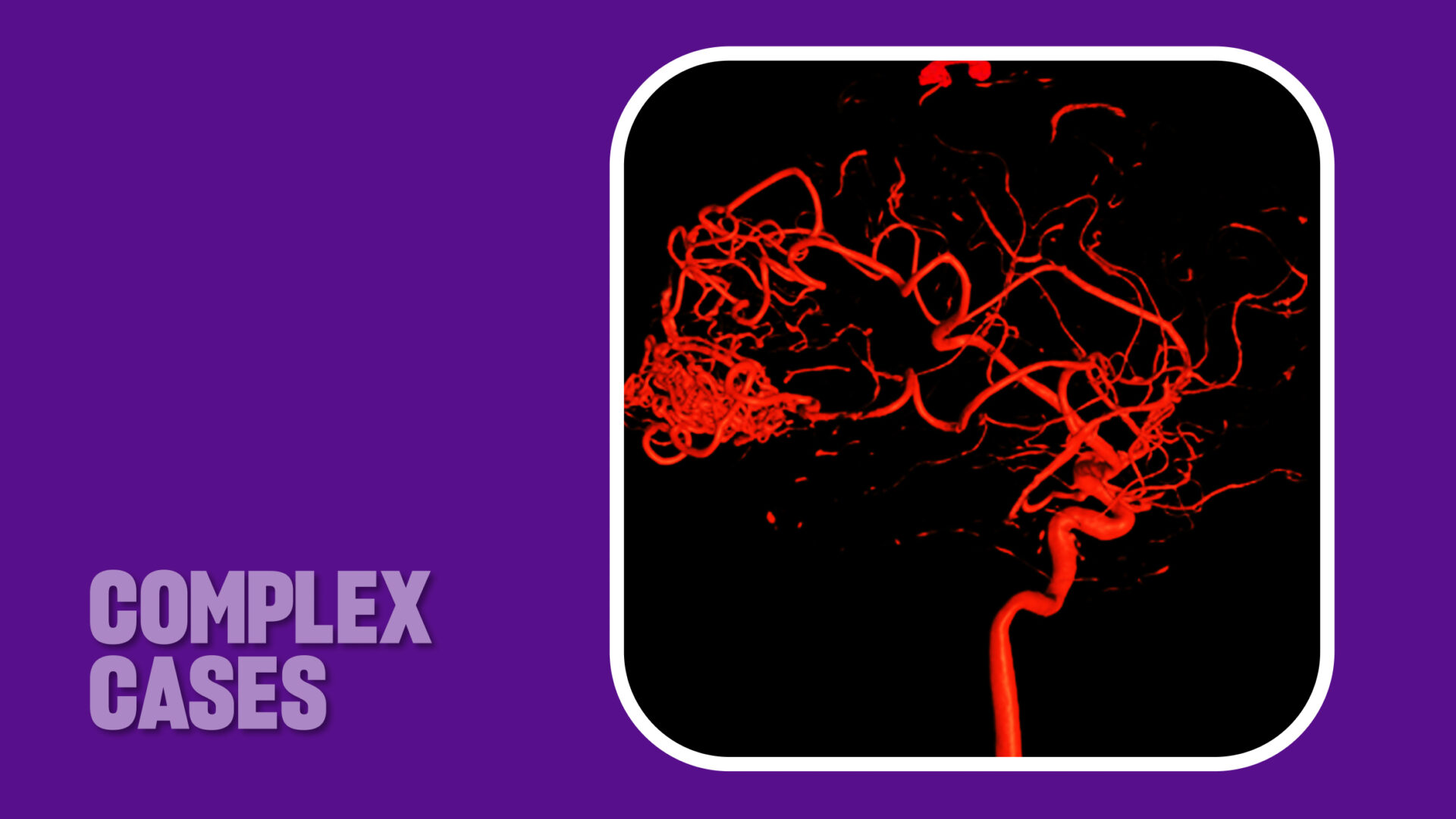 An angiogram showing the patient's arteriovenous malformation.