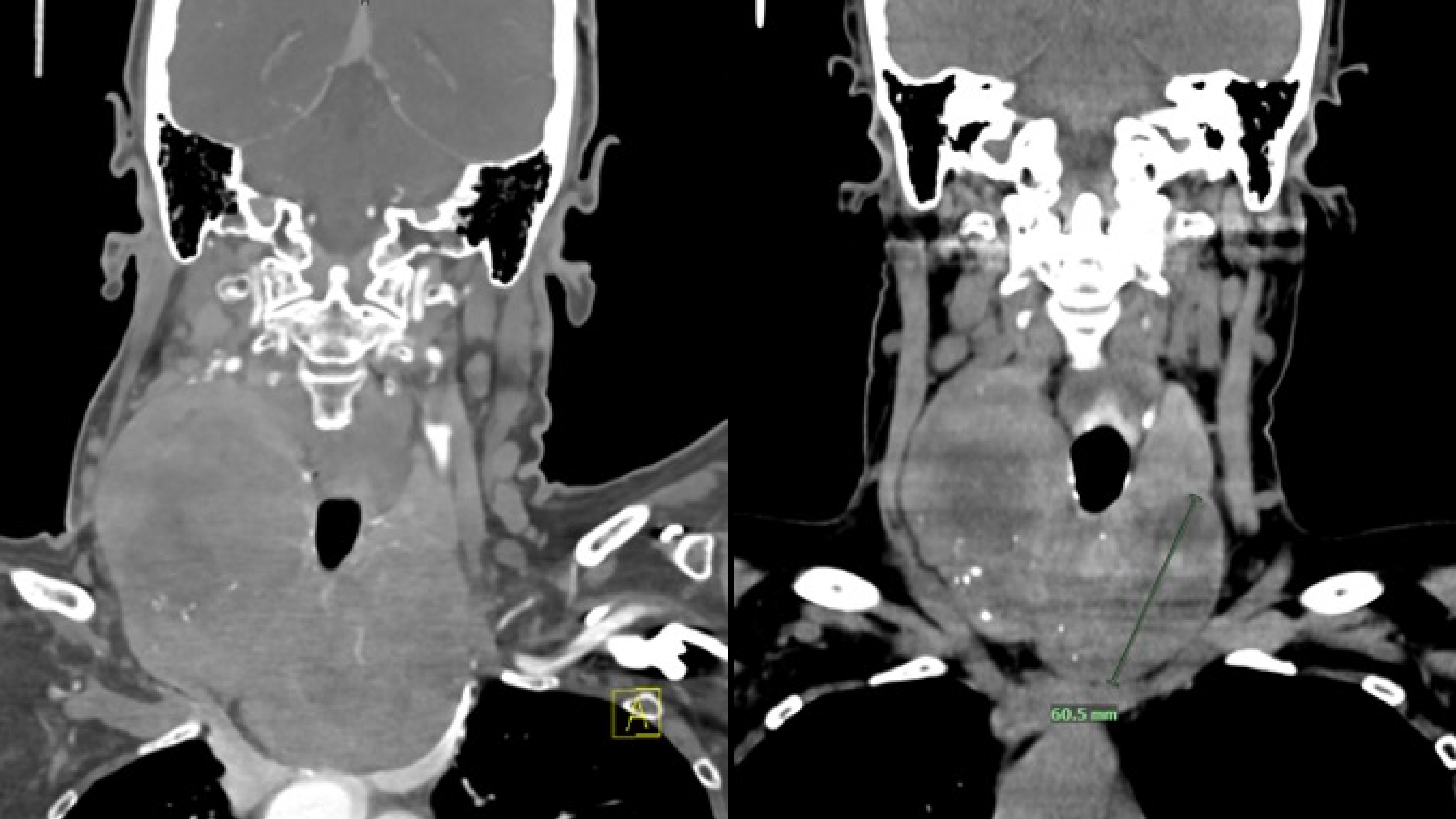 CT scans of a patient’s goiter, shown before TAE (left) and 5-months after TAE (right).