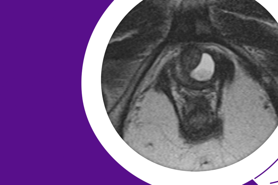 Axial T2 MRI showing the patient’s semi-circumferential urethral diverticulum.