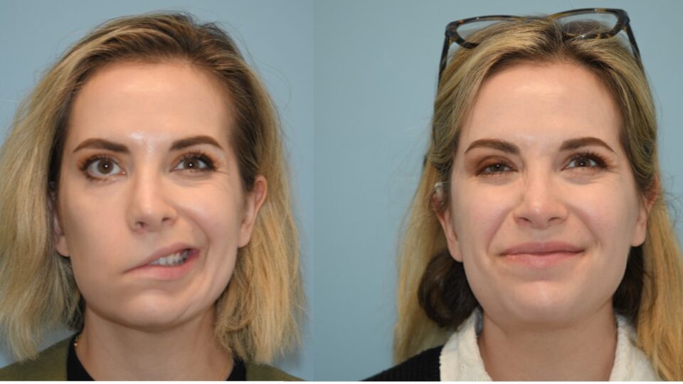 The patient before (left) and after (right) facial reanimation surgery. Source: NYU Langone Health