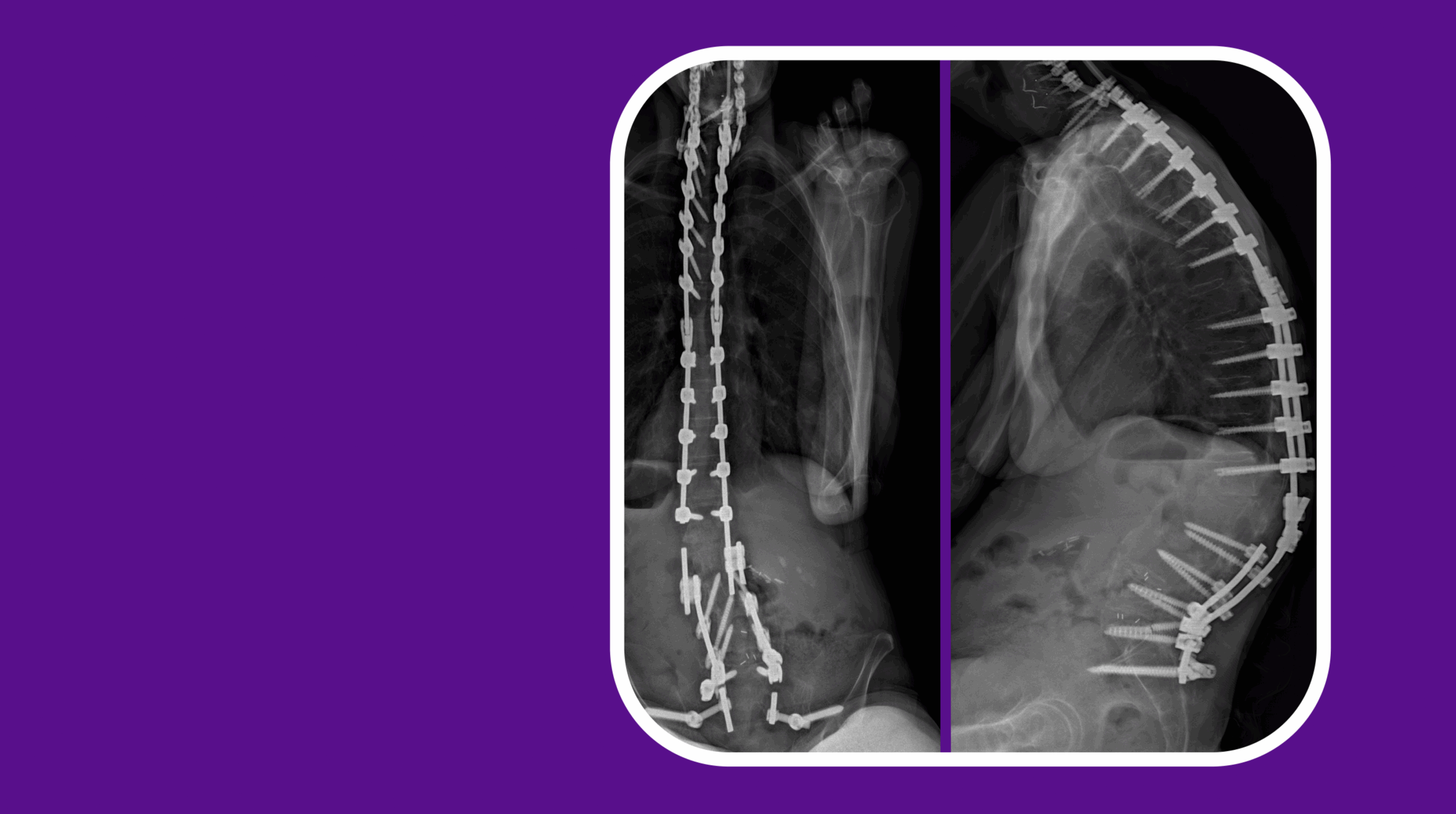 PSO Corrects Severe Spinal Deformity Due to Multiple Failed Back
