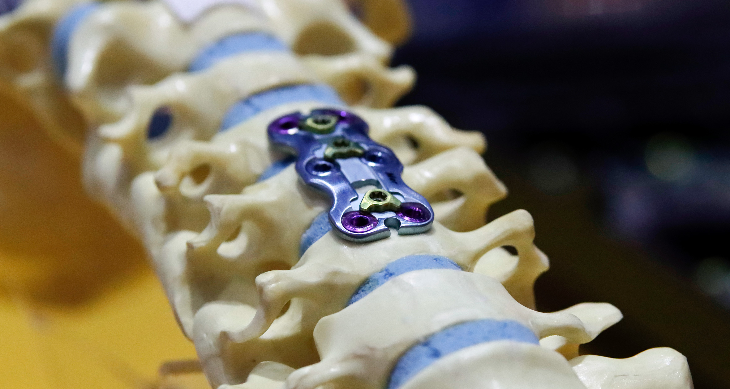 Examining Screw Fixation Techniques in ASD Surgery | NYU Langone